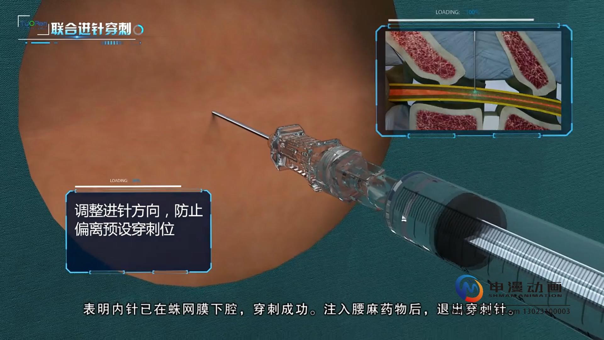 微创腰麻套针产品演示动画