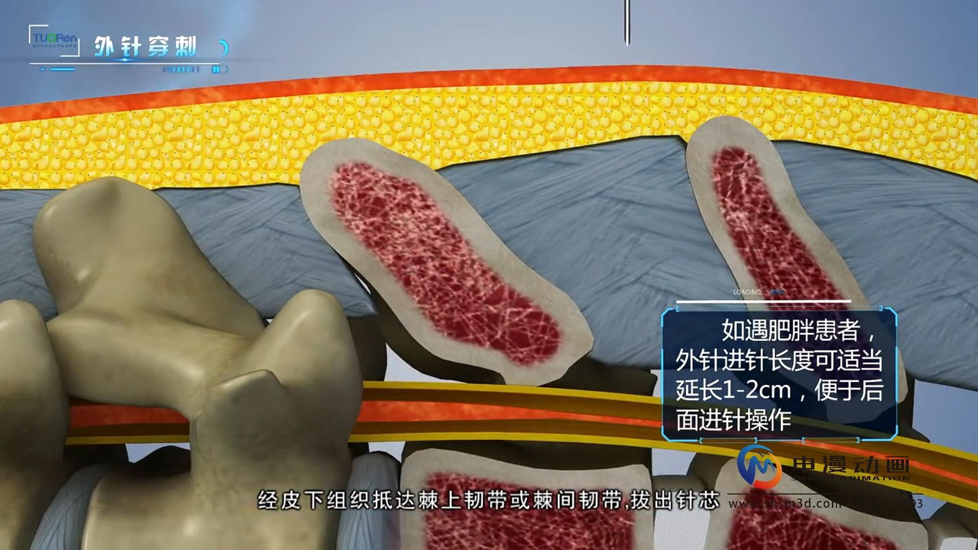 微创腰麻套针产品演示动画
