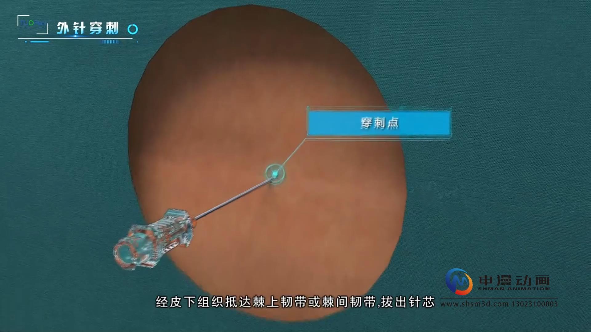 微创腰麻套针产品演示动画